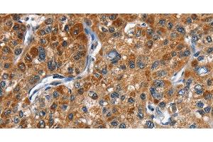 Immunohistochemistry of paraffin-embedded Human liver cancer tissue using DRAK2 Polyclonal Antibody at dilution 1:40 (DRAK2 Antikörper)