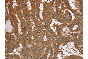 The image on the left is immunohistochemistry of paraffin-embedded Human thyroid cancer tissue using ABIN7192090(RAB14 Antibody) at dilution 1/40, on the right is treated with synthetic peptide. (RAB14 Antikörper)