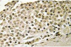 Immunohistochemistry (IHC) analyzes of Cerebral 1 antibody in paraffin-embedded human breast carcinoma tissue. (APP Antikörper)