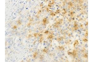 ABIN6263736 and ABIN6266891 at 1/100 staining human prostate carcinoma by IHC-P. (NRIP2 Antikörper  (N-Term))