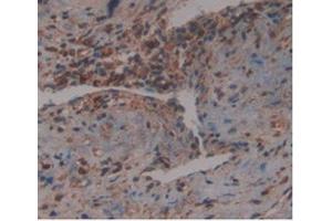 IHC-P analysis of Human Prostate Gland Cancer Tissue, with DAB staining. (GDF3 Antikörper  (AA 251-364))