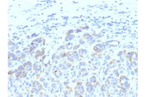 Formalin-fixed, paraffin-embedded human Melanoma stained with TYRP1 MAB (SPM611) (Tyrosinase-Related Protein 1 Antikörper)