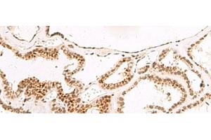 Immunohistochemistry of paraffin-embedded Human thyroid cancer tissue using DGCR6L Polyclonal Antibody at dilution of 1:65(x200) (DGCR6L Antikörper)
