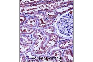 HTRA2 Antibody (N-term) (ABIN657628 and ABIN2846624) immunohistochemistry analysis in formalin fixed and paraffin embedded human kidney carcinoma followed by peroxidase conjugation of the secondary antibody and DAB staining. (HTRA2 Antikörper  (N-Term))