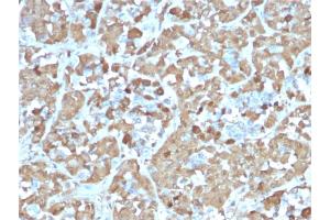 Formalin-fixed, paraffin-embedded human Pituitary stained with Growth Hormone Recombinant Mouse Monoclonal Antibody (rGH/1450). (Rekombinanter Growth Hormone 1 Antikörper  (AA 58-187))