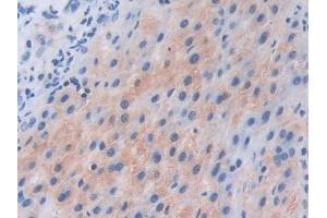IHC-P analysis of Human Liver cancer Tissue, with DAB staining. (PIK3CB Antikörper  (AA 807-1070))