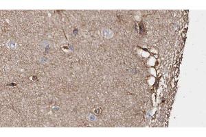 ABIN6279059 at 1/100 staining Human brain cancer tissue by IHC-P. (ABLIM1 Antikörper  (N-Term))
