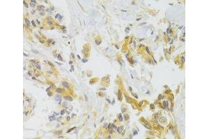 Immunohistochemistry of paraffin-embedded Human breast cancer using EIF4G1 Polyclonal Antibody at dilution of 1:100 (40x lens). (EIF4G1 Antikörper)
