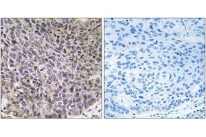Immunohistochemistry analysis of paraffin-embedded human lung carcinoma tissue, using Cytochrome P450 4B1 Antibody. (CYP4B1 Antikörper  (AA 141-190))