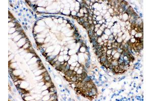 Immunohistochemistry (Paraffin-embedded Sections) (IHC (p)) image for anti-Isocitrate Dehydrogenase 1 (NADP+), Soluble (IDH1) (AA 381-413), (C-Term) antibody (ABIN3043855) (IDH1 Antikörper  (C-Term))