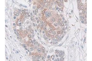 DAB staining on IHC-P; Samples: Human Prostate cancer Tissue (SERPINB5 Antikörper  (AA 1-375))