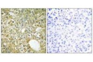 Immunohistochemistry analysis of paraffin-embedded human breast carcinoma tissue using ACVL1 antibody. (ACVRL1 Antikörper)