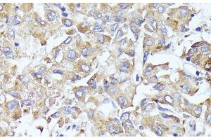 Immunohistochemistry of paraffin-embedded Human liver cancer using EIF3L Polyclonal Antibody at dilution of 1:100 (40x lens). (EIF3L Antikörper)