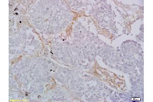 Formalin-fixed and paraffin embedded human lung carcinoma labeled with Rabbit Anti CD8 Polyclonal Antibody, Unconjugated (ABIN1385272) at 1:200 followed by conjugation to the secondary antibody and DAB staining (CD8 Antikörper  (AA 51-150))