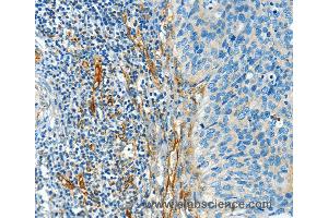 Immunohistochemistry of Human cervical cancer using DIO2 Polyclonal Antibody at dilution of 1:50 (DIO2 Antikörper)