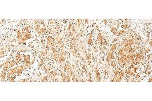 Immunohistochemistry of paraffin-embedded Human prost ate cancer tissue using RPS27A Polyclonal Antibody at dilution of 1:40(x200) (RPS27A Antikörper)