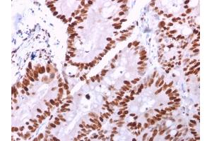 Formalin-fixed, paraffin-embedded human Colon Carcinoma stained with MCM6 Mouse Monoclonal Antibody (MCM6/2999). (MCM6 Antikörper  (AA 228-368))