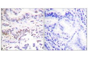 Immunohistochemistry analysis of paraffin-embedded human lung carcinoma tissue using XRCC3 antibody.