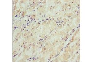 Immunohistochemistry of paraffin-embedded human gastric cancer using ABIN7171148 at dilution of 1:100 (SNAP29 Antikörper  (AA 1-258))