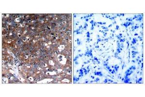 Immunohistochemical analysis of paraffin-embedded human breast carcinoma tissue, using IGF-1R (Ab-1346) antibody (E021303). (IGF1R Antikörper)