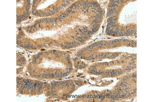 Immunohistochemistry of Human ovarian cancer using S100A4 Polyclonal Antibody at dilution of 1:80 (s100a4 Antikörper)