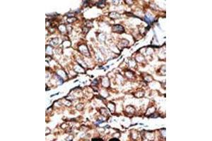 Formalin-fixed and paraffin-embedded human cancer tissue reacted with the primary antibody, which was peroxidase-conjugated to the secondary antibody, followed by DAB staining.