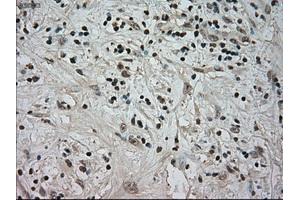 Immunohistochemical staining of paraffin-embedded Carcinoma of kidney tissue using anti-NTRK3mouse monoclonal antibody.