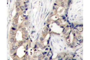 Immunohistochemistry of paraffin-embedded Human breast carcinoma using Phospho-ABL1(Y412) Polyclonal Antibody (ABL1 Antikörper  (pTyr412))