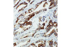 Anti-CYP2U1 antibody, IHC(P) IHC(P): Human Intestinal Cancer Tissue (CYP2U1 Antikörper  (C-Term))