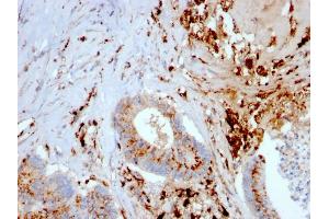 Formalin-fixed, paraffin-embedded human Liver Carcinoma and Macrophages stained with Cathepsin D Mouse Monoclonal Antibody (CTSD/3082).
