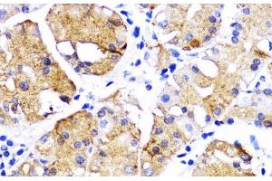 Immunohistochemistry of paraffin-embedded Human gastric cancer using BMPR1B Polyclonal Antibody at dilution of 1:200 (40x lens). (BMPR1B Antikörper)
