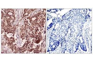 Immunohistochemical analysis of paraffin-embedded human breast carcinoma tissue, using NFκB-p105/p50 (Phospho-Ser927) antibody (E011312). (NFKB1 Antikörper  (pSer927))