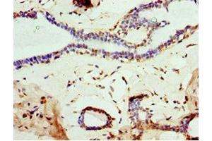 Immunohistochemistry of paraffin-embedded human breast cancer using ABIN7160457 at dilution of 1:100