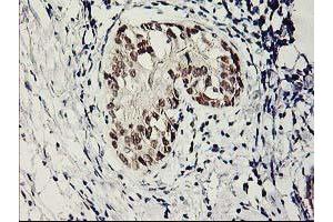 Immunohistochemical staining of paraffin-embedded Adenocarcinoma of Human breast tissue using anti-SERPINB13 mouse monoclonal antibody. (SERPINB13 Antikörper)