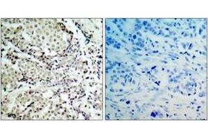 Immunohistochemistry analysis of paraffin-embedded human breast carcinoma tissue, using MKK6 (Ab-207) Antibody. (MAP2K6 Antikörper  (AA 173-222))