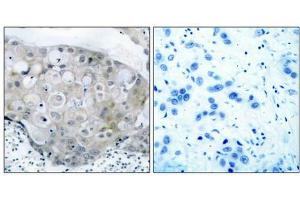Immunohistochemical analysis of paraffin-embedded human breast carcinoma tissue using VEGFR2(Phospho-Tyr951) Antibody(left) or the same antibody preincubated with blocking peptide(right). (VEGFR2/CD309 Antikörper  (pTyr951))