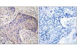 Immunohistochemistry analysis of paraffin-embedded human prostate carcinoma tissue, using ST6GAL1 Antibody. (ST6GAL1 Antikörper  (AA 171-220))