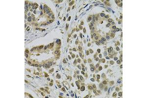 Immunohistochemistry of paraffin-embedded human breast cancer using EBAG9 Antibody (ABIN5970999) at dilution of 1/100 (40x lens). (RCAS1 Antikörper)