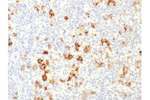 Formalin-fixed, paraffin-embedded human Hodgkin's Lymphoma stained with CD15 Rabbit Polyclonal Antibody. (CD15 Antikörper)