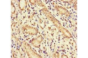 Immunohistochemistry of paraffin-embedded human gastric cancer using ABIN7154769 at dilution of 1:100