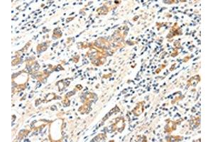 The image on the left is immunohistochemistry of paraffin-embedded Human gastric cancer tissue using ABIN7192279(SCN2A Antibody) at dilution 1/25, on the right is treated with synthetic peptide. (SCN2A Antikörper)