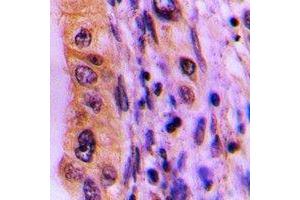 Immunohistochemical analysis of PHLDA3 staining in human lung cancer formalin fixed paraffin embedded tissue section. (PHLDA3 Antikörper)
