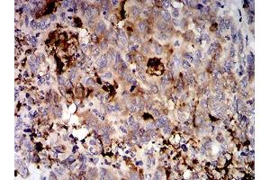 Immunohistochemical analysis of paraffin-embedded stomach cancer tissues using MUC5AC mouse mAb with DAB staining. (MUC5AC Antikörper  (AA 5528-5627))