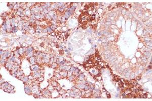 Immunohistochemistry of paraffin-embedded Human colon carcinoma using MZB1 Polyclonal Antibody at dilution of 1:100 (40x lens).