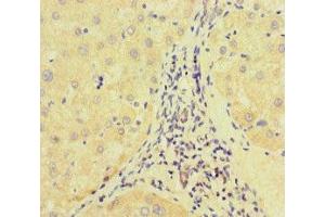 Immunohistochemistry of paraffin-embedded human liver cancer using ABIN7172513 at dilution of 1:100 (E2F1 Antikörper  (AA 133-362))