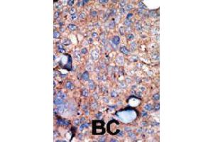 Formalin-fixed and paraffin-embedded human breast cancer tissue reacted with IKBKE polyclonal antibody  , which was peroxidase-conjugated to the secondary antibody, followed by AEC staining. (IKKi/IKKe Antikörper  (C-Term))