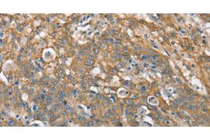Immunohistochemistry of paraffin-embedded Human gastric cancer tissue using CSMD1 Polyclonal Antibody at dilution 1:40
