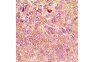 Immunohistochemical analysis of Laminin Receptor staining in human breast cancer formalin fixed paraffin embedded tissue section. (RPSA/Laminin Receptor Antikörper)
