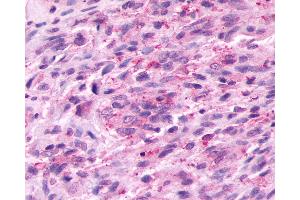 Anti-PROKR2/Prokineticin Receptor 2 antibody IHC of human Brain, Glioblastoma. (Prokineticin Receptor 2 Antikörper  (C-Term))