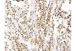 ABIN7094692 and ABIN7098743 at 1/100 staining Human pancreatic cancer by IHC-P.